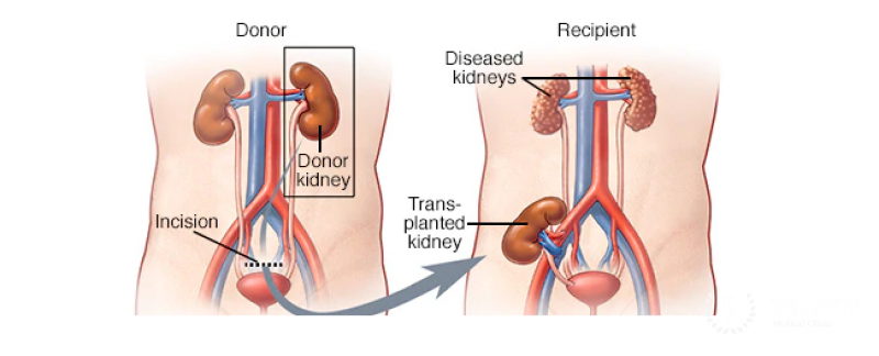 Kidney Transplant in ahmedabad